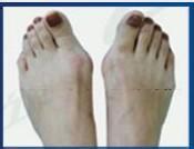 拇外翻的日常保健措施有哪些 拇外翻的日常保健措施有哪些