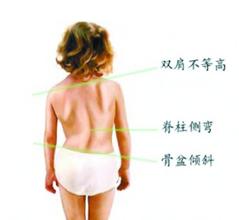 青少年脊柱侧弯多缘于不良坐姿 青少年脊柱侧弯多缘于不良坐姿