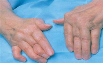 类风湿2.jpg 类风湿2.jpg