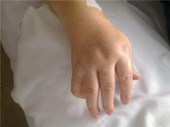 类风湿44.jpg 类风湿44.jpg