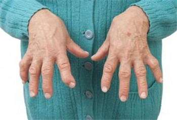 类风湿11.jpg 类风湿11.jpg