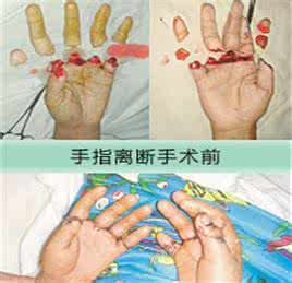 断指的临床分类.jpg 断指的临床分类.jpg