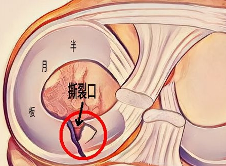 半月板损伤.png 半月板损伤.png